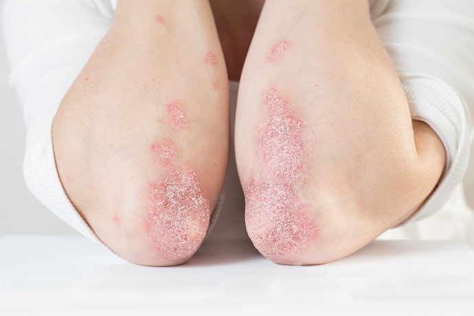 Psoriasis, une prise en charge inégale - AVENIR SANTÉ MUTUELLE